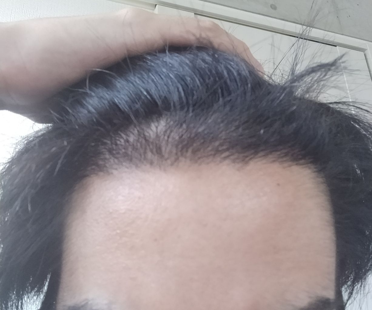 3ヶ月半 順調です M字ハゲ21歳の韓国植毛moten医院