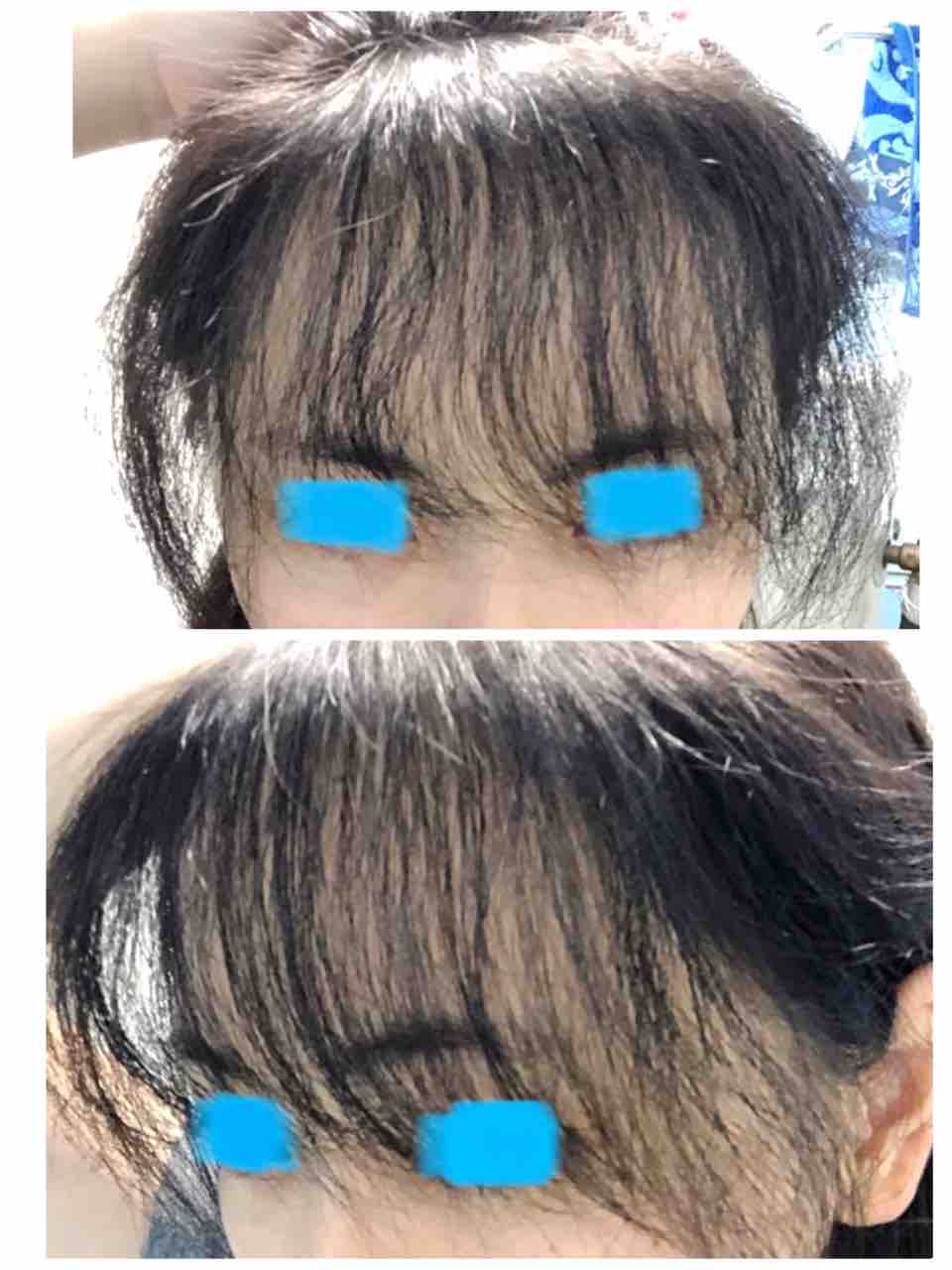 女性のfue自毛植毛in韓国 女性のfue自毛植毛in韓国