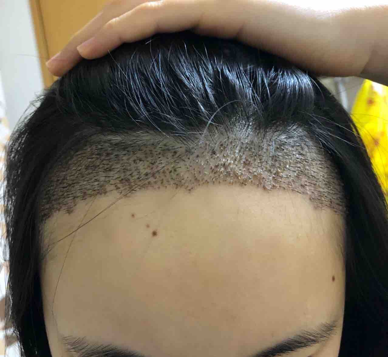 18年11月 女性のfue自毛植毛in韓国