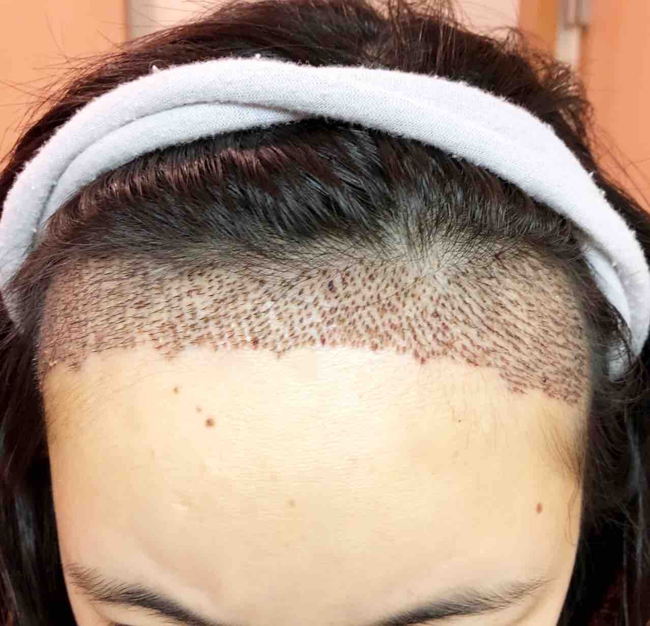 18年11月 女性のfue自毛植毛in韓国