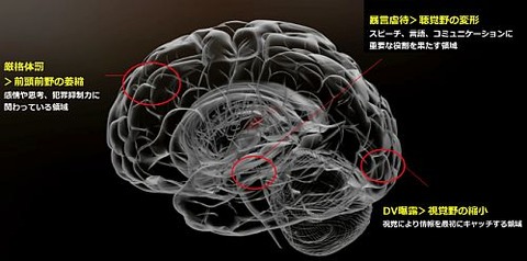 傷つく脳