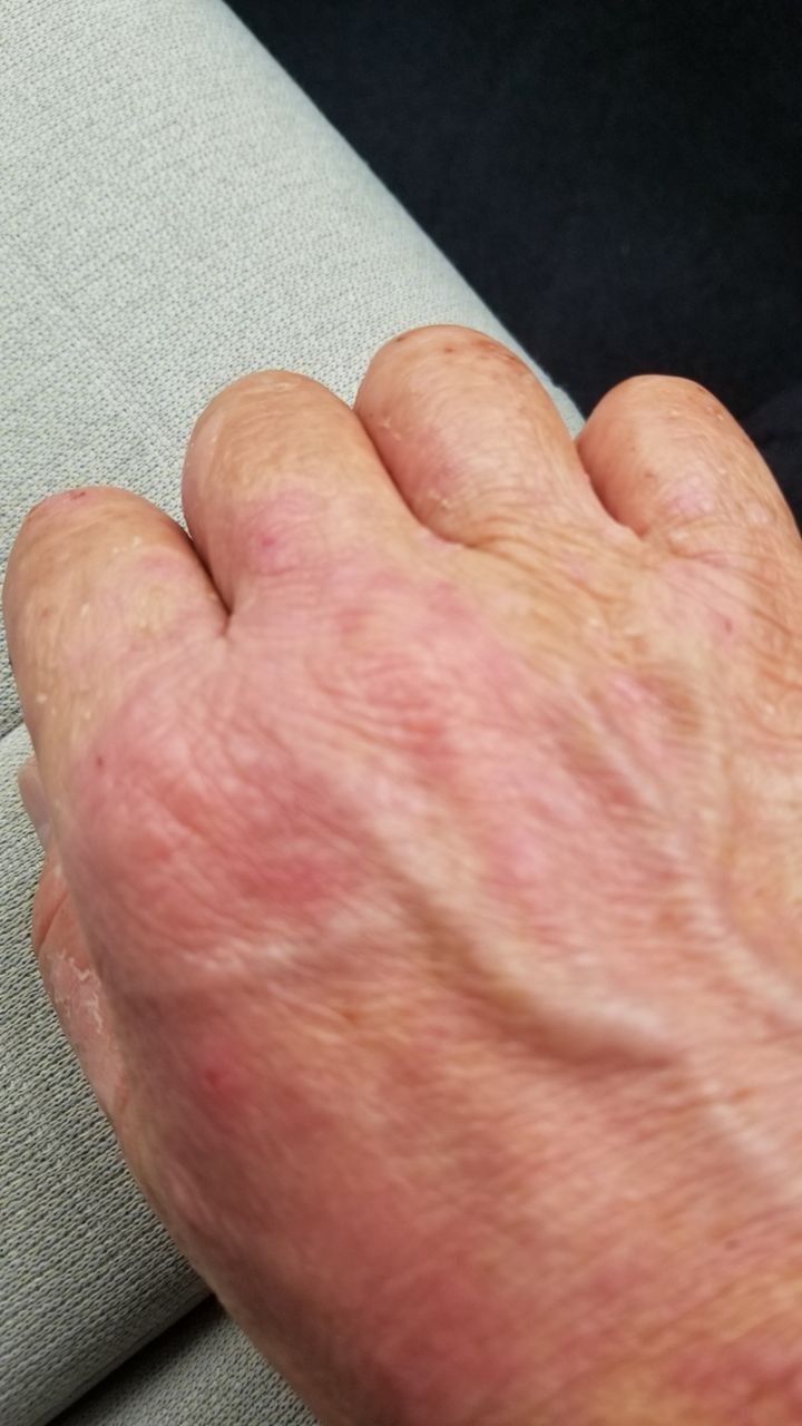 手の甲のシミを取ってみる これから先のことは