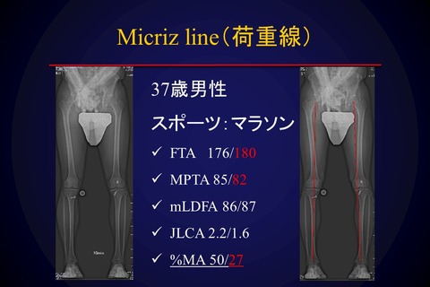 Myアライメント