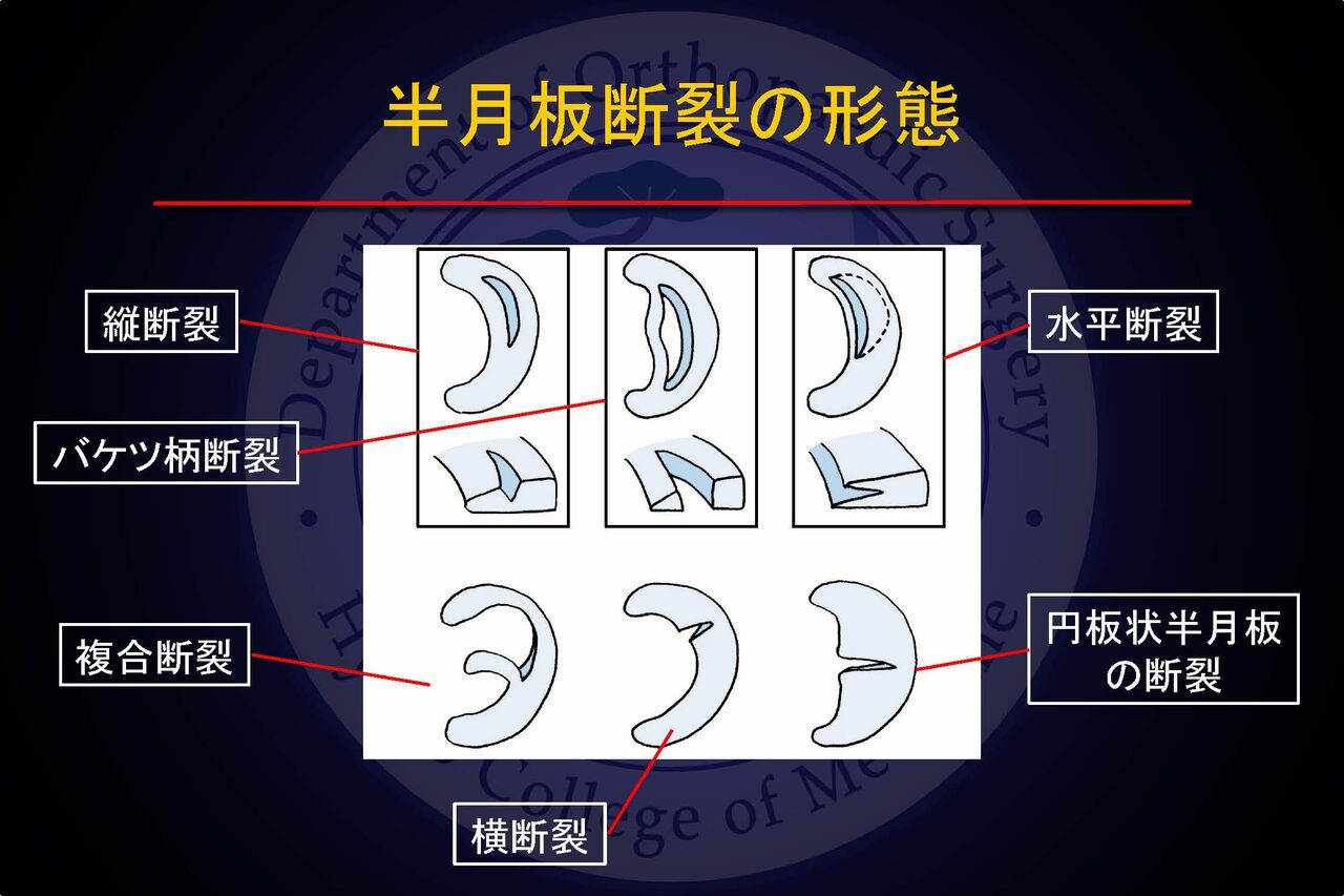 半月板 マラソン膝関節外科医のブログ 半月板 マラソン膝関節外科医のブログ