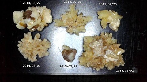 尿路結石って何であんなに命を刈り取る形してるん がんばりノート 2chまとめ 尿路結石って何であんなに命を刈り取る形してるん がんばりノート 2chまとめ