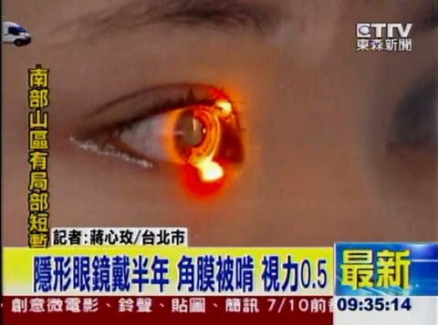 【ヤベェ】女子大生が半年間コンタクトレンズをつけっぱなしにした結果→微生物に角膜を食べられる危険な病気「アカントアメーバ角膜炎」にかかり失明の危機