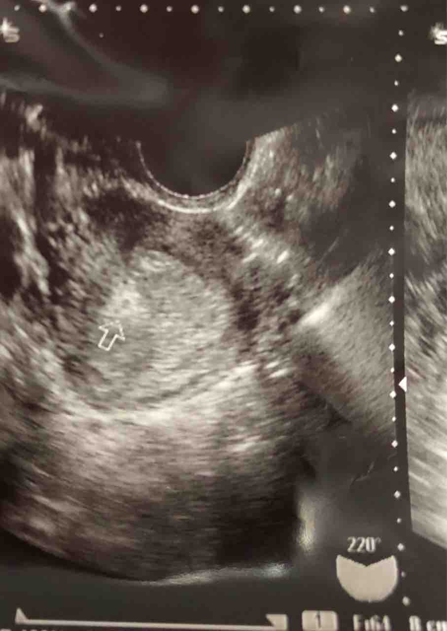 高温期日目 胎嚢確認出来ず 2人っ子計画 流産を乗り越えて2人目妊活中