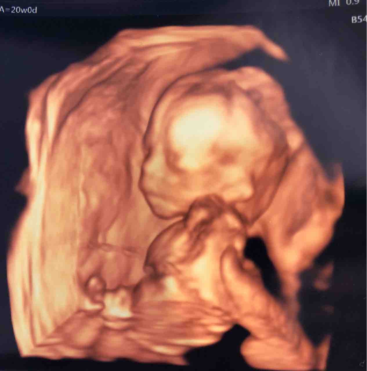 w6d 胎児スクリーニング 4d 2人っ子計画 流産を乗り越えて2人目妊活中