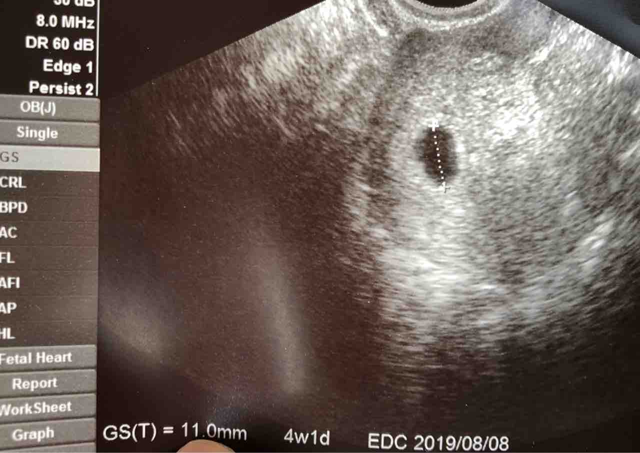 5w4d 胎嚢確認 ホッとした 2人っ子計画 流産を乗り越えて2人目妊活中