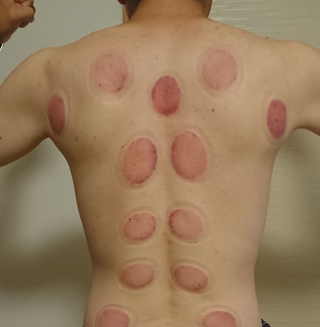 メディカルカッピング 格闘技 マッサージs Keep公式ブログ