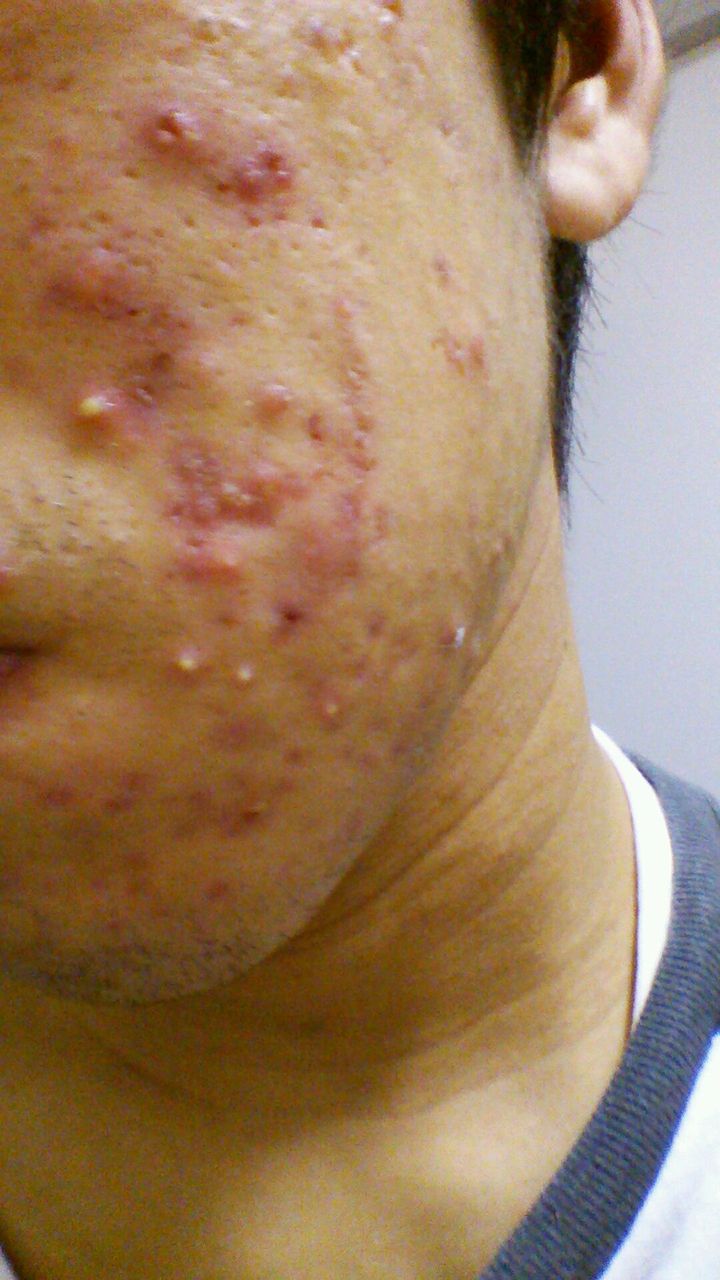 ニキビがぜんぜん治らないから人生諦めた スキンケアまとめ