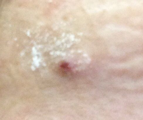 ひまし油でほくろを取る 途中経過 捨てて何もない家に まちエモン