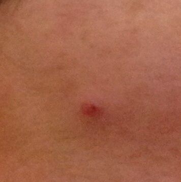 ひまし油でほくろを取る 途中経過 捨てて何もない家に まちエモン