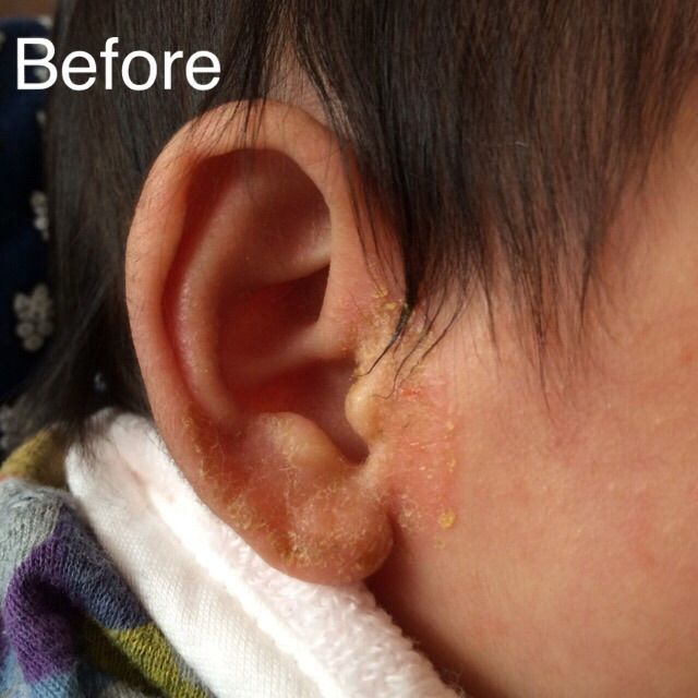 耳の乳児湿疹 赤ちゃんと出会う その日まで そして