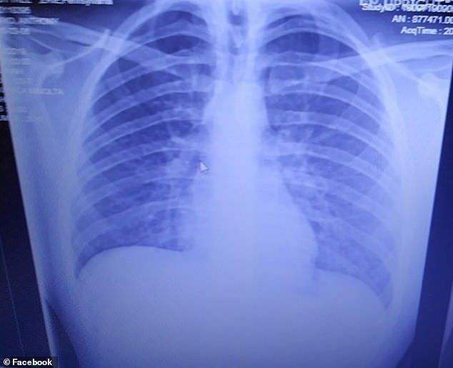 １日２箱の喫煙者の肺 電子タバコの蒸気を２年間吸い続けた少年 肺に油脂が詰まり６０歳のヘビースモーカーと同じになってしまう 米国 すもーるnewsちゃんねる