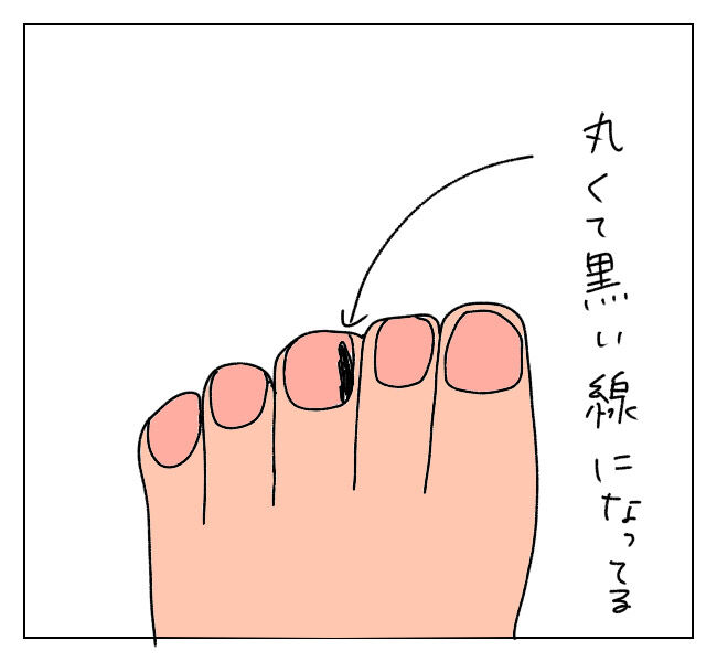 足の爪の黒い線で癌の疑い 1 半笑いの日々 足の爪の黒い線で癌の疑い 1 半笑いの日々
