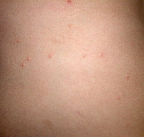 子供にできた水イボ 治療方法は 今日から始める雑記ブログ