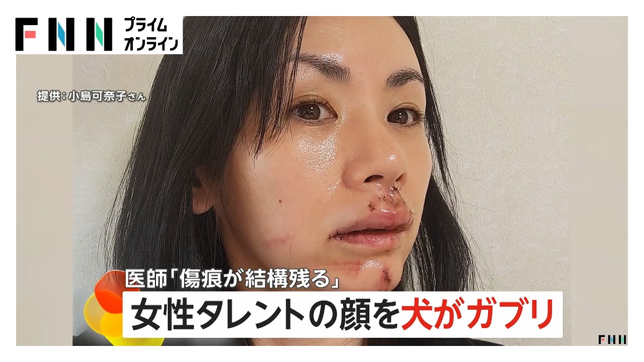 【悲報】小島可奈子に犬がガブリ、30針も縫った模様…やばすぎやろ！
