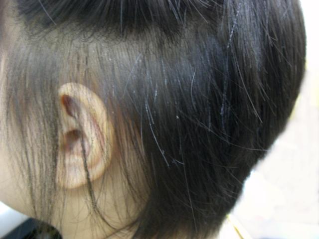 憎っき しらみ を 薬を使わないで やっつけよう 09年08月 Livedoor Blog ブログ