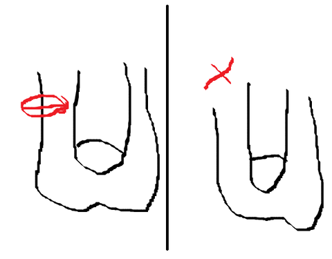 パイプカット手術箇所