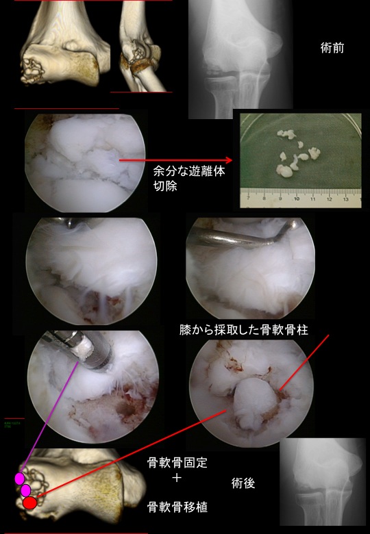 Elbow Arthroscopy 肘関節鏡視下手術 スポーツ整形外科医s Uのブログ Sports Physician S U Blog