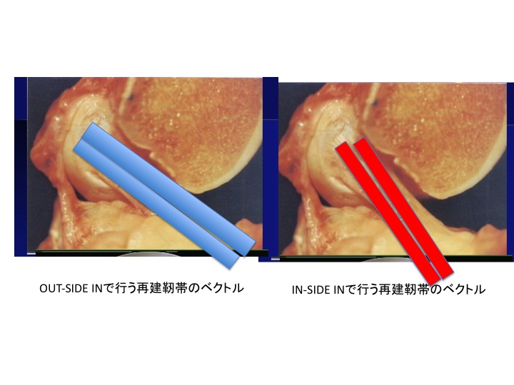 前十字靭帯再建術(ACL再建術）Double bundle ACL reconstruction