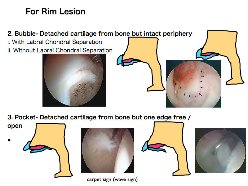 股関節痛の原因 関節唇損傷以外の病態 関節軟骨解離 cartilage 股関節痛の原因 関節唇損傷以外の病態 関節軟骨解離 cartilage