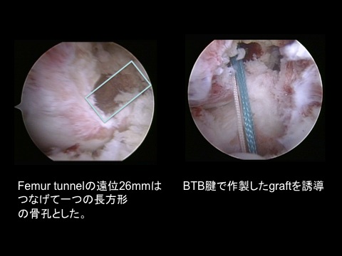 前十字靭帯再建術後に再断裂 再再建術 Acl Revision の極意 Modified Rectangular Btb Revisionでも神の手で作ったナチュラルaclに近づく工夫 スポーツ整形外科医s Uのブログ Sports Physician S U Blog 前十字靭帯再建術後に再断裂 再再建術 Acl Revision の極意 Modified Rectangular Btb Revisionでも神の手で作ったナチュラルaclに近づく工夫 スポーツ整形外科医s Uのブログ Sports Physician S U Blog