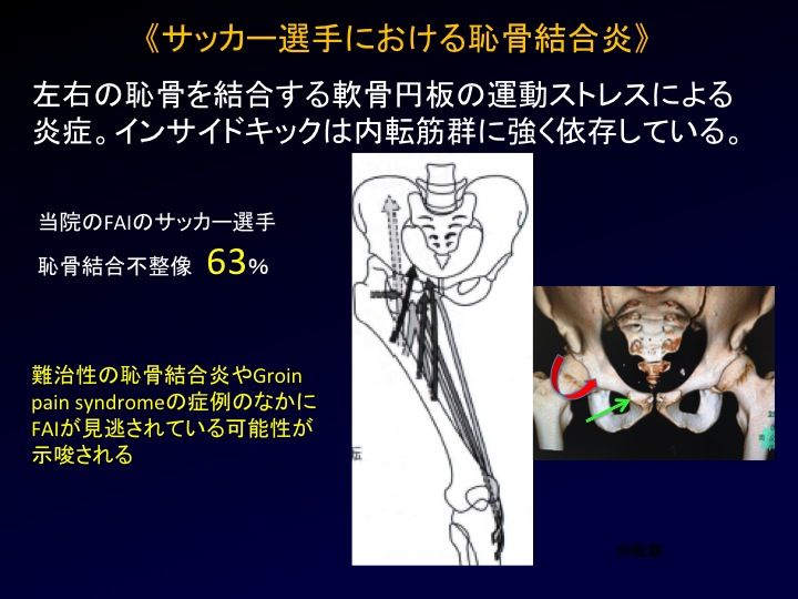 サッカー選手の股関節痛の原因 Fai 股関節インピンジメント 恥骨結合炎合併多い スポーツ整形外科医s Uのブログ Sports Physician S U Blog サッカー選手の股関節痛の原因 Fai 股関節インピンジメント 恥骨結合炎合併多い スポーツ整形外科医s Uのブログ Sports Physician S U Blog