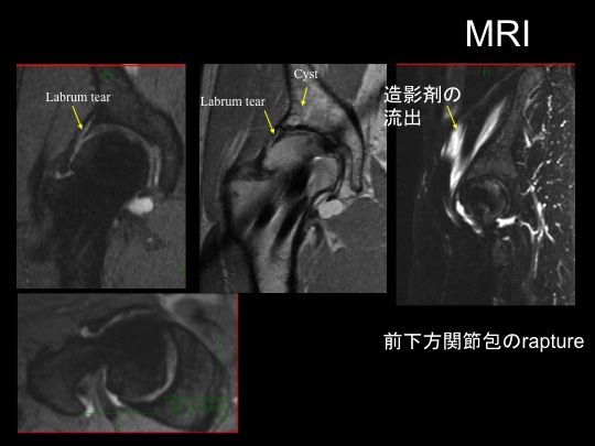 大腿骨頚部骨折後に続く股関節痛の原因 股関節インピンジメントに対する治療戦略 スポーツ整形外科医s Uのブログ Sports Physician S U Blog 大腿骨頚部骨折後に続く股関節痛の原因 股関節インピンジメントに対する治療戦略 スポーツ整形外科医s Uのブログ Sports Physician S U Blog
