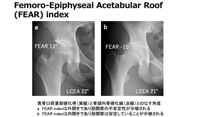 股関節 単純レントゲン写真 （単純x線）パラメーターの測定の