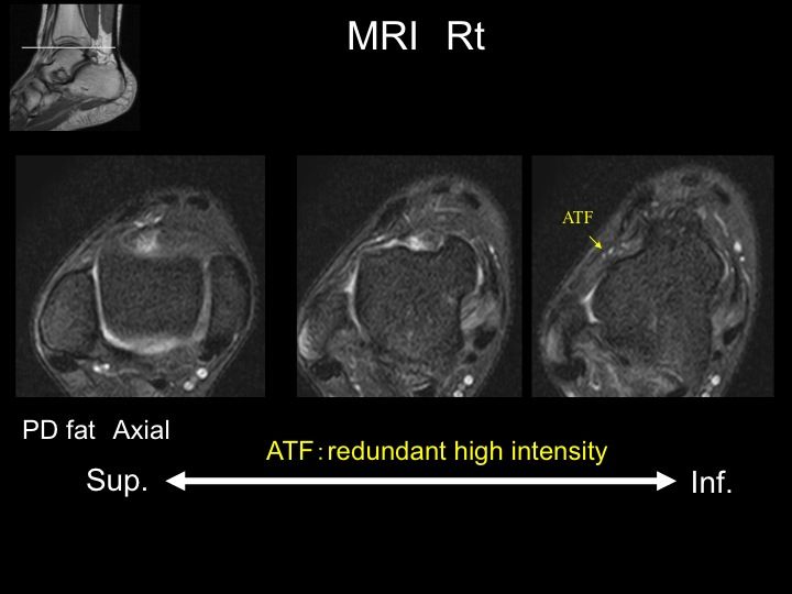 足首の繰り返すねんざや不安定に最小侵襲手術 登場 Ankle Arthroscopic Brostrom Repair With Gould Augmentation スポーツ整形外科医s Uのブログ Sports Physician S U Blog 足首の繰り返すねんざや不安定に最小侵襲手術 登場 Ankle Arthroscopic Brostrom Repair With Gould Augmentation スポーツ整形外科医s Uのブログ Sports Physician S U Blog