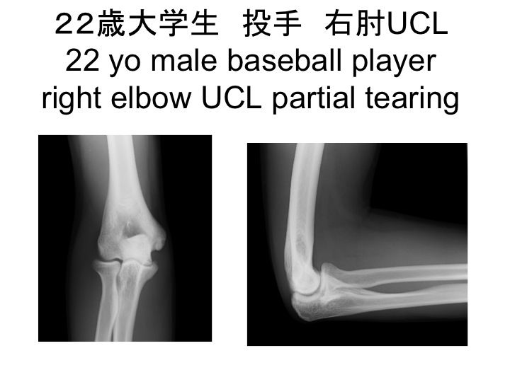 Elbow Arthroscopy 肘関節鏡視下手術 スポーツ整形外科医s Uのブログ Sports Physician S U Blog