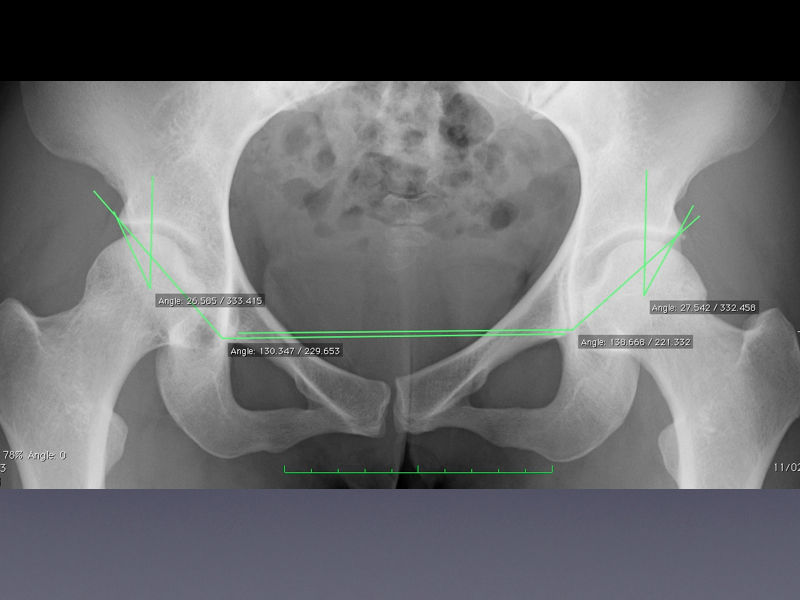 ボルダリングによる股関節唇損傷を股関節鏡視下手術でがっちり治す スポーツ整形外科医s Uのブログ Sports Physician S U Blog