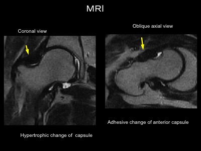 2010年最難関手術 ベスト3 Hip Revision Arthroscopy : スポーツ 2010年最難関手術 ベスト3 Hip Revision Arthroscopy : スポーツ