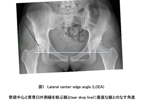 股関節 単純レントゲン写真 （単純x線）パラメーターの測定の