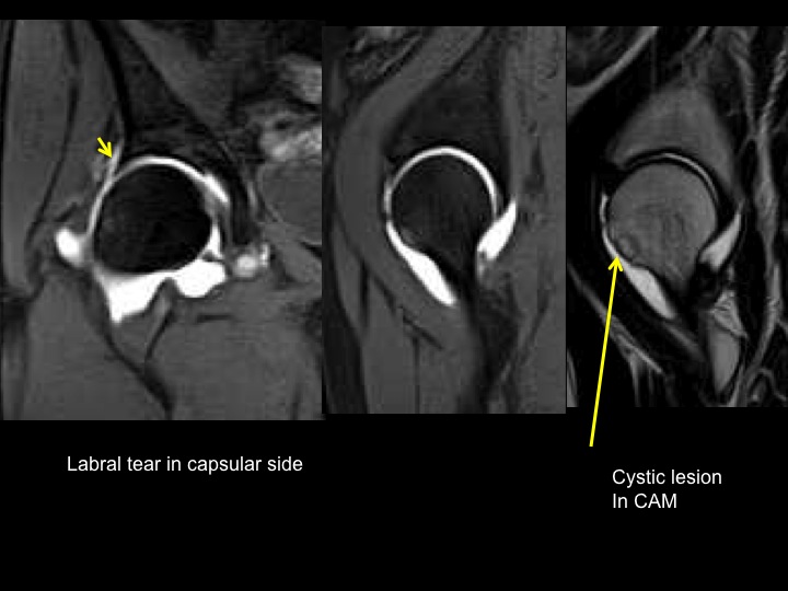 Hip Arthroscopy 股関節鏡視下手術 スポーツ整形外科医s Uのブログ Sports Physician S U Blog Hip Arthroscopy 股関節鏡視下手術 スポーツ整形外科医s Uのブログ Sports Physician S U Blog