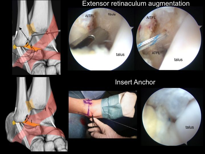 足首の繰り返すねんざや不安定に最小侵襲手術 登場 Ankle