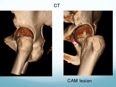 臼蓋形成不全に対する 画像診断方法 False Profile スポーツ整形外科医s Uのブログ Sports Physician S U Blog