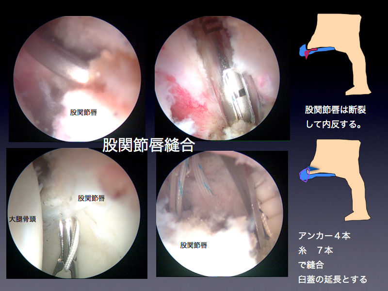 ボルダリングによる股関節唇損傷を股関節鏡視下手術でがっちり治す スポーツ整形外科医s Uのブログ Sports Physician S U Blog