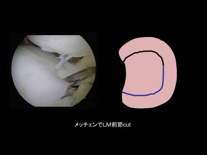 小児の外側円板状半月板に対する関節鏡視下手術 縫合して形成 盃形成手術 Saucerization スポーツ整形外科医s Uのブログ Sports Physician S U Blog 小児の外側円板状半月板に対する関節鏡視下手術 縫合して形成 盃形成手術 Saucerization スポーツ整形外科医s Uのブログ Sports Physician S U Blog