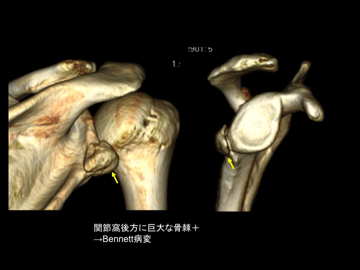保存療法で治らない肩のbennett Lesionを関節鏡視下に治療する スポーツ整形外科医s Uのブログ Sports Physician S U Blog