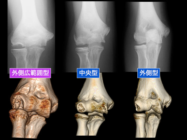 思春期の野球選手にみられる 肘離断性骨軟骨炎（OCD)末期 鏡視下手術で