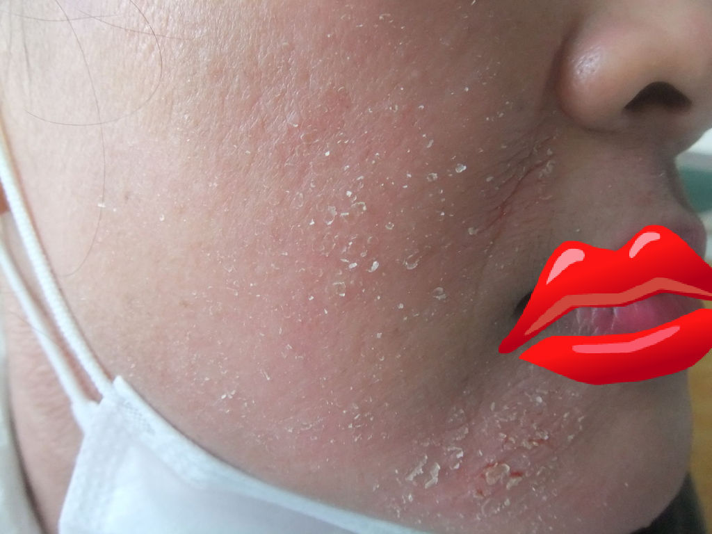 アトピー肩こりだるい体から脱却するまで