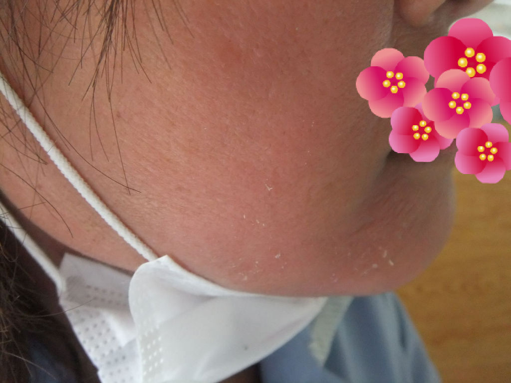 アトピー肩こりだるい体から脱却するまで