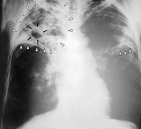 280px-Tuberculosis-x-ray-1