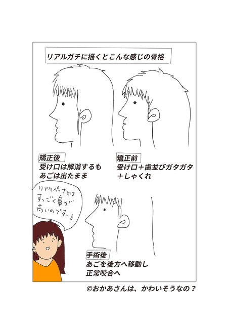 顎変形症 下顎の治療のみを決断 手術日決定 元毒親育ちのじぶん改造ダイアリー おかあさんは かわいそうなの