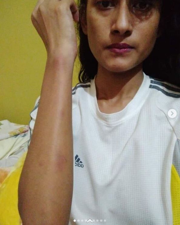 Priyadarshini Narayan Yadav Injuries