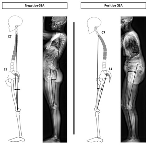 Spinal_deformityに関するreview_Neurosurg__pdf（3___16ページ）