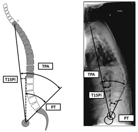 Spinal_deformityに関するreview_Neurosurg__pdf(3___16ページ)